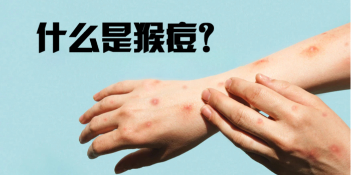 猴痘：它是什么，如何预防？